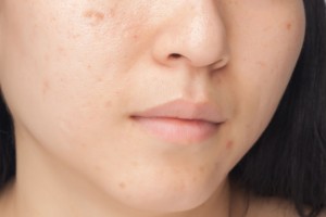 Eliminazione cicatrici acne