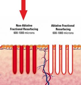 Laser frazionato non ablativo a confronto con laser frazionato ablativo